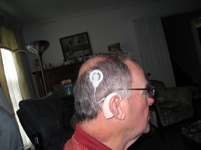 cochlear implant